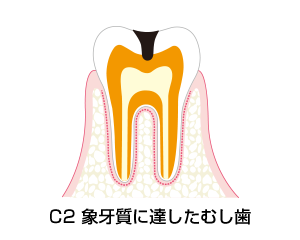 C2－象牙質に達したむし歯