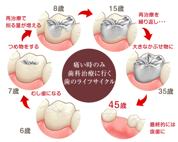 再治療を繰り返すと最終的には抜歯へ