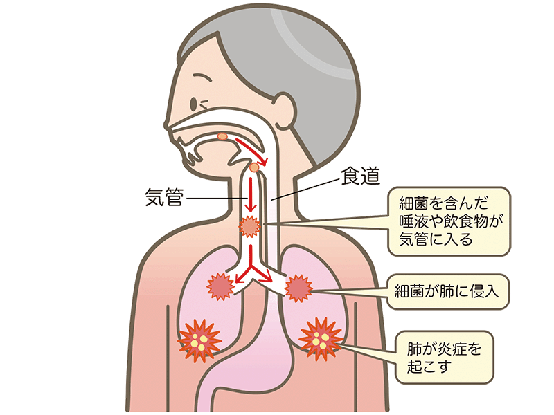 誤嚥性肺炎の図