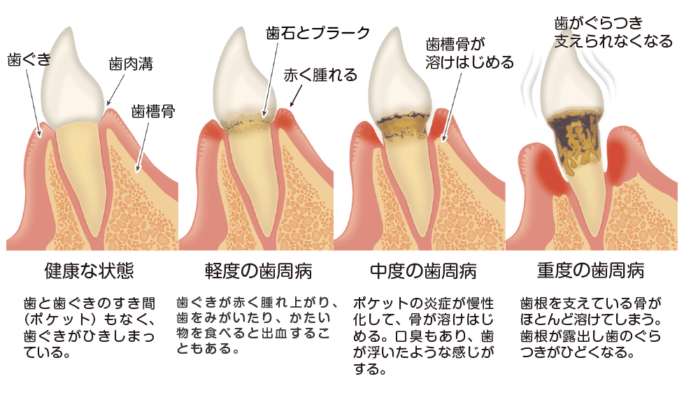 歯周病の進行