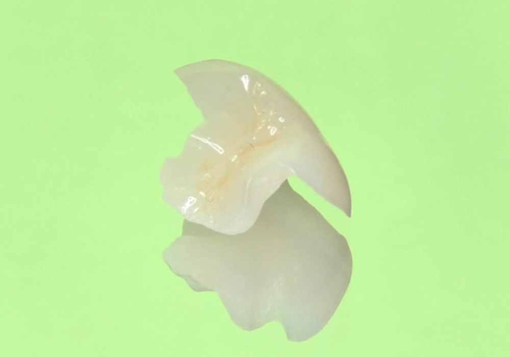 補綴物